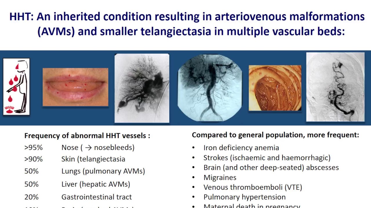 An Overview Of Hereditary Haemorrhagic Telangiectasia (HHT) By Prof ...