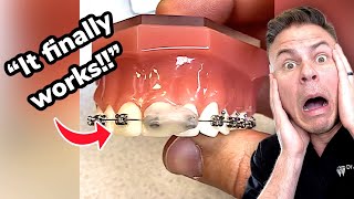 Braces Life Hack! The Secret To Wax They Don’t Want You To Know!