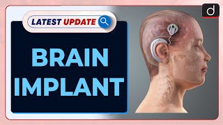 Brain Implant | Epilepsy | Latest Update | Drishti IAS English