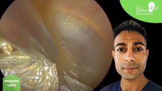 1,098 - Dead Skin Peel off Eardrum and Ear Canal