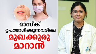 മാസ്‌ക് ധരിക്കുന്നവരിൽ ഉണ്ടാവുന്ന മുഖക്കുരു മാറാൻ | Pimple Remove Tips