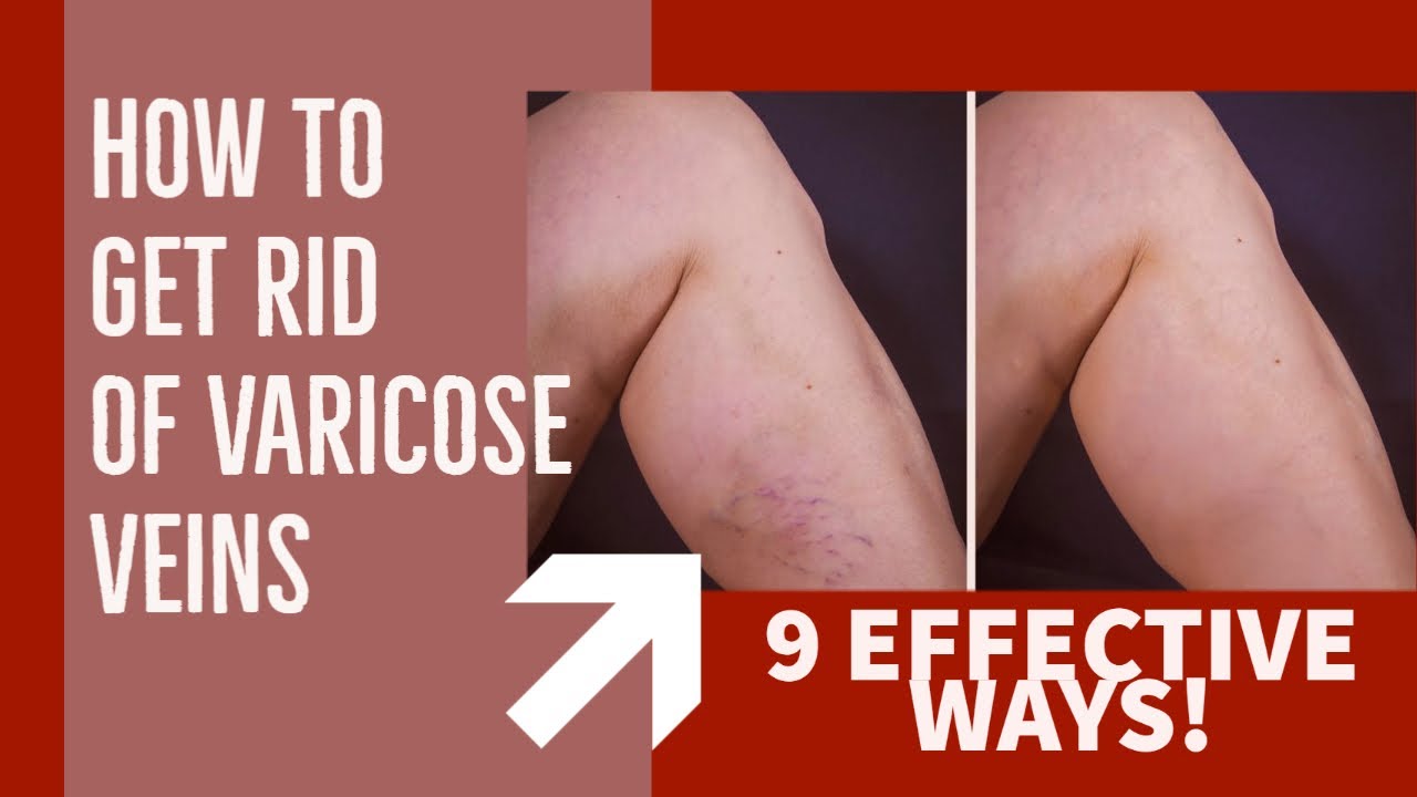 Varicose Veins Treatment - 9 Natural Ways To Get Rid Of Varicose Veins ...