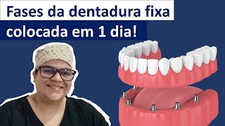 Passo-a-passo da dentadura fixa em 1 dia| Dra Bianca Rosa