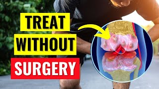 Knee Arthritis Treatments Without Surgery