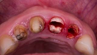 Socket shield for 2 adjacent implant sites.