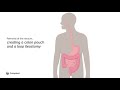 Anatomy of Loop Ileostomy and Pouch (Removed Rectum)