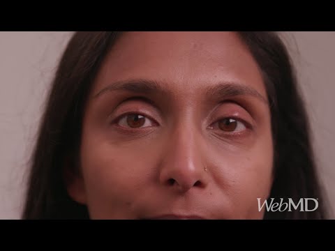 How to Treat a Stye | WebMD How to Treat a Stye | WebMD