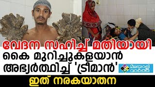 Tree man വേദന സഹിച്ച് മതിയായി,  കൈ മുറിച്ചുകളയാന്‍  അഭ്യര്‍ത്ഥിച്ച് 'ട്രീമാന്‍' ഇത് നരകയാതന