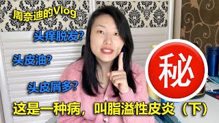 周奈迪vlog | 缓解治疗脂溢性皮炎（下）：如何正确洗头？这几种搭配使用效果佳！| Seborrheic dermatitis | hair loss | shampoo properly