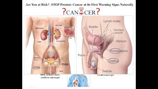 Are you at Risk STOP Prostate Cancer at its First Warning Signs  Naturally
