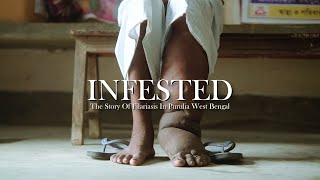 Infected : The Story of Filariasis In Purulia, West Bengal | Documentary by Daniel Erasmus