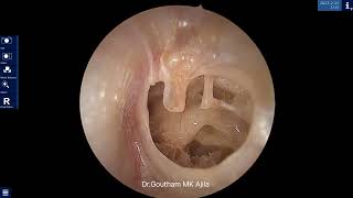 Inside the Ear: Otoendoscopic View of a Perforated Ear Drum. Dr Goutham MK Ajila