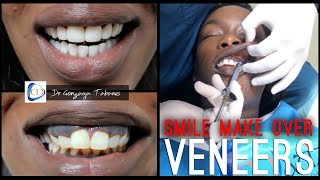 My Colombian SMILE MAKEOVER | Non Prep Veneers w/ Clinicas Matizz