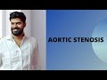 AORTIC STENOSIS - CAUSES , CLINICAL FEATURES, INVESTIGATION, TREATMENT