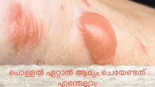 പൊള്ളൽ ഏറ്റാൽ ആദ്യം ചെയേണ്ടത് എന്തെല്ലാം /how to treat burn /in Malayalam