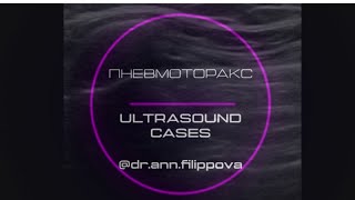 ПНЕВМОТОРАКС на УЗИ 💥💭 Pneumothorax. Ultrasound Cases.⠀