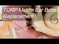 Middle Ear Bone Total Replacement - Total Ossicular Replacement Prosthesis (TORP) for Hearing Loss