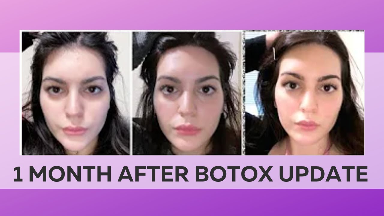 Getting Botox Brow Lift Before After Vlog Vrogue Co Getting Botox Brow Lift Before After Vlog Vrogue Co