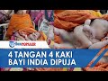 🔴 Bayi Lahir dengan Empat Tangan dan Empat Kaki, Bayi India Ini Dipuja Sebagai 