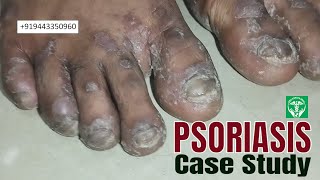 All about Psoriasis in Siddha Way I Safe & Effective I Case study I தொற்றா நோய் சொரியாசிஸ் ISelvin's