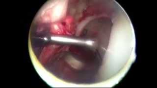 Arthroscopic Assisted Trochlear Resurfacing - Dr. Douglas Wyland