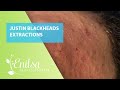 Justin Blackheads Extractions 4th Treatment Part 1