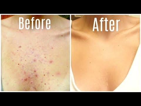 How I Got Rid Of My Body Acne FOREVER! How I Got Rid Of My Body Acne FOREVER!