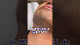 【閲覧注意⚠️】ヒゲ半分脱毛した１ヶ月後がコチラ！抜けすぎてごめん🙇‍♂️