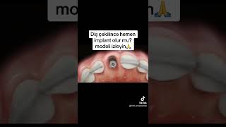 Diş çekilince anında implant yapılır mı? #laminediş #zirkonyumkaplama #implant #zirkonia