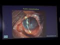 AIOC 2023 GP84 topic Dr  Shreyas Ramamurthy Ocular Cicatricial Pemphigoid Clinical approach and opti