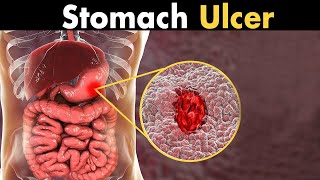 What causes a stomach ulcer?
