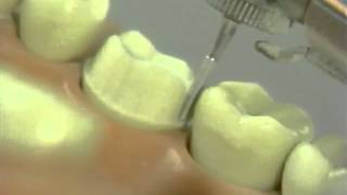 Complete Cast Crown Prep - Part 2
