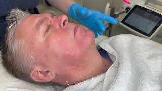 Fotona SP Dynamis Men 4D facelift training video