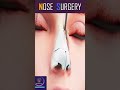 rhinoplasty nose surgery nasalsurgery