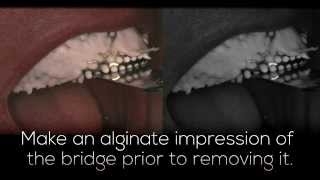 Temporary Dental Bridge