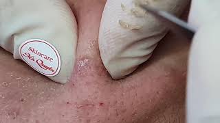 |352| Blackheads \u0026 Acne treatment in Ha Quyen Spa on 16/02/2021 (Full  version)