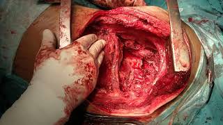 Thoracoplasty(2) Dr. Ravindra Kumar Dewan