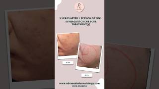 3in1 Synergistic Acne Scar Treatment - RF Fractional Microneedling, TCA CROSS, Subcision