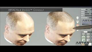 Watch an ARTAS Robotic Hair Restoration Procedure - ARTAS Hair Transplant Florida