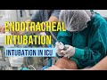 #Endotracheal #intubation: Step by step procedure