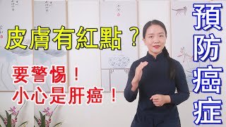 一旦皮肤出现这些“小红点”，多半是肝肾出问题！第1个是肝癌信号，别以为是过敏【健康管理师李晓】