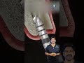 பல் பதியம் எப்படி செய்வார்கள்? -How a Dental Implant Procedure is Done? |Dr.Karthikeyan |Denta Kings