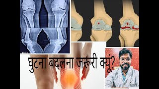 Knee replacement, is it necessary।घुटना बदलना फायदेमंद है?