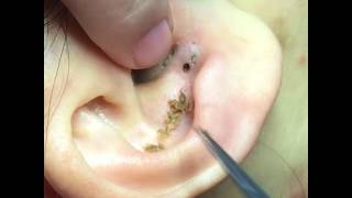 Giant ear acne - Blackhead Acne Removal