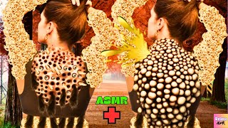 ASMR Infected By Trypophobia Remove From Back | ASMR Urgent Treatment | ASMR Animation | Relaxo ASMR