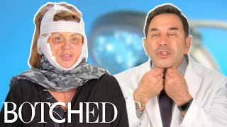 Dr Nassif Fixes Lisa S Facelift Gone Wrong Full Transformation Botched E