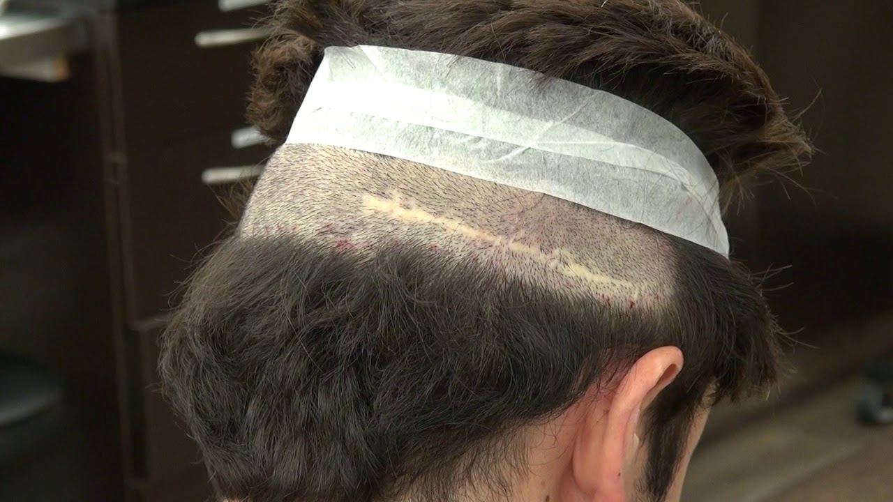 Demonstration Of The FUT Liner Scar By Dr. Diep Hair Transplant San ...