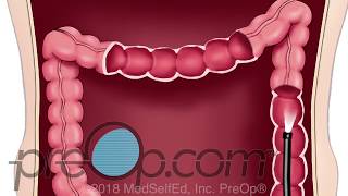 Lower Endoscopy - Lower GI - Colonoscopy Procedure - PreOp® Patient Education