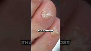 Trimming of SUPER THICK BIG TOENAILS!!!