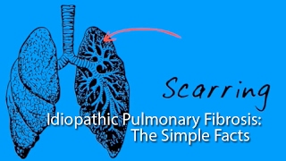 Idiopathic Pulmonary Fibrosis: The Simple Facts